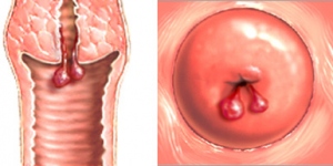 Polip na maternici - cervikalni polip