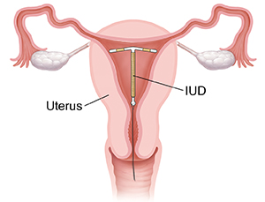 Spirala - interuderini uložak (IUD)