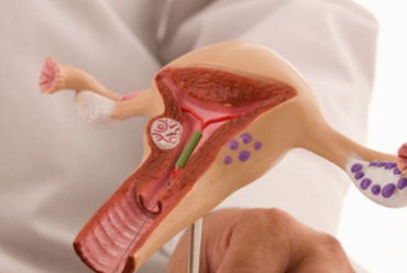 Sve što trebate znati o spirali ili intrauterinom ulošku (IUD), a niste imali koga pitati